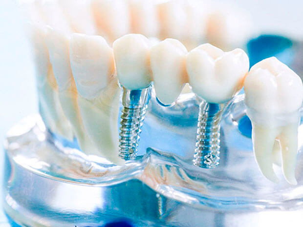 зубные коронки на имплантах
