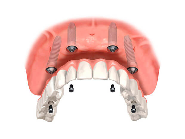 Имплантация зубов All-on-4